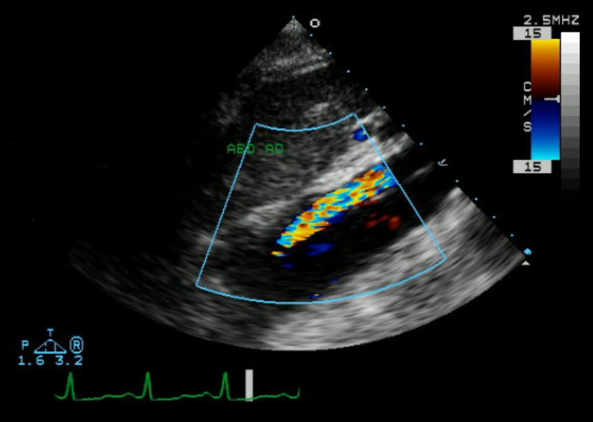 Echocardiogram, such as this image of an aortic dissection, has been used to promote heart health. But doctors have also used echocardiograms to help spot the signs of COVID-19.